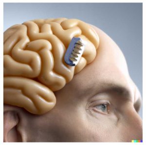 Brain-chip-implants-in-a-human